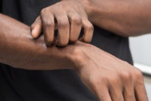 Tips on managing itch